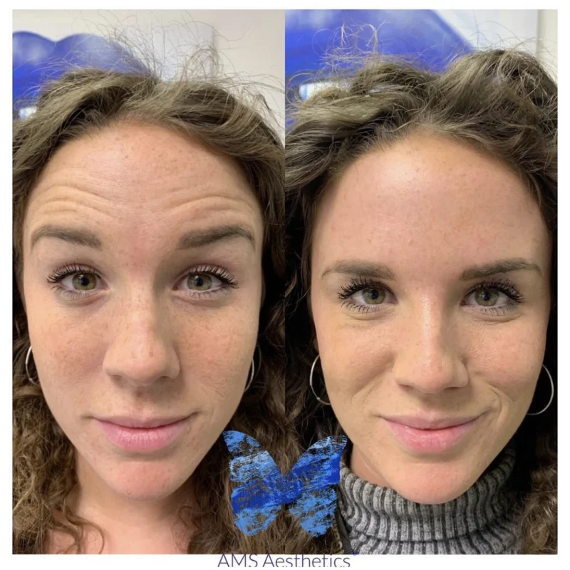Anti Wrinkle - Before After 1