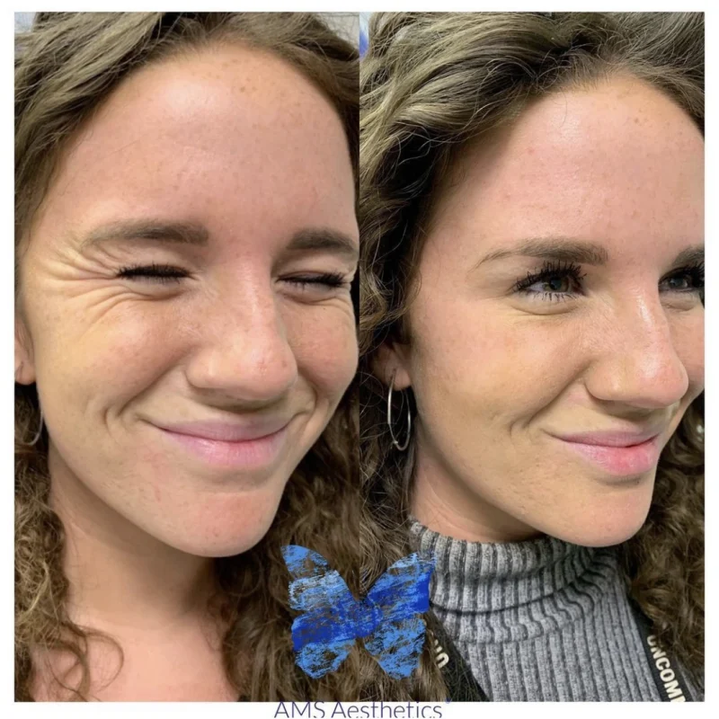 Anti Wrinkle - Before After 2