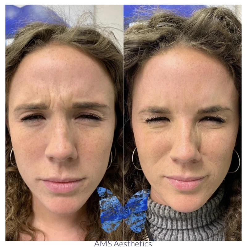 Anti Wrinkle - Before After 3