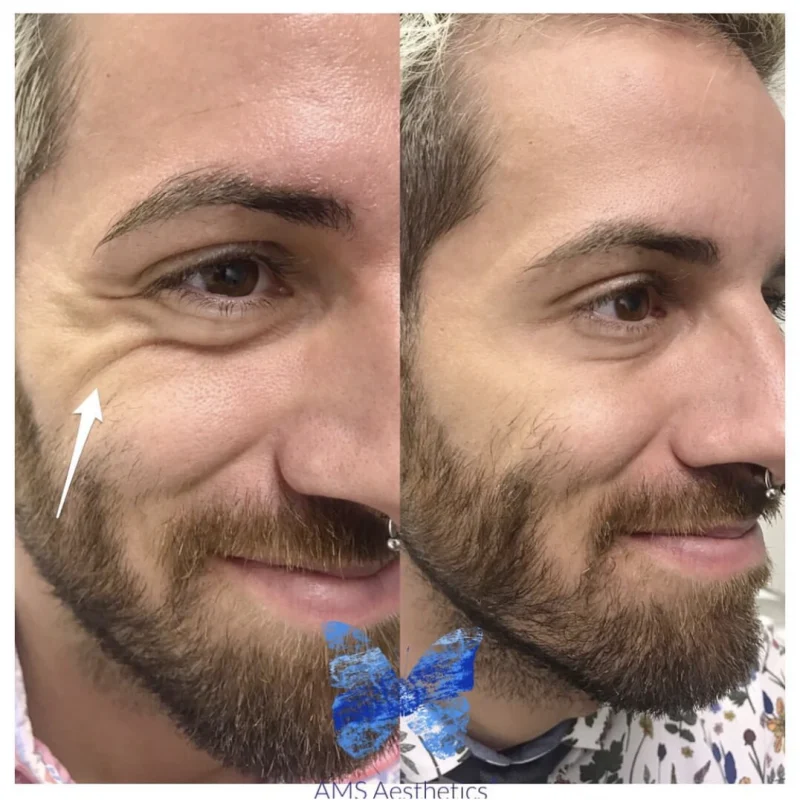 Anti Wrinkle - Before After 4