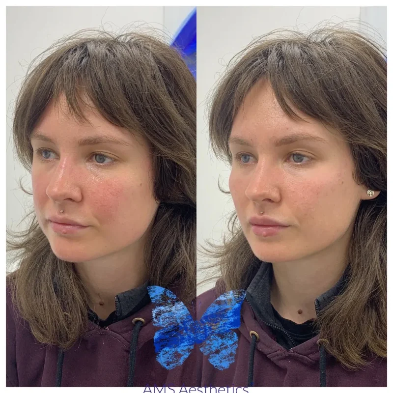 Cheek Enhancement - Before and Afters 1