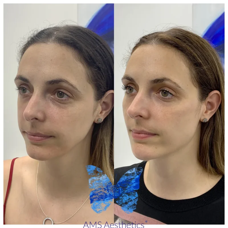 Cheek Enhancement - Before and Afters 11