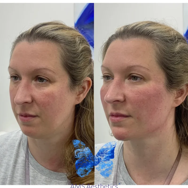 Cheek Enhancement - Before and Afters 12