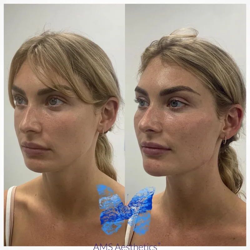 Cheek Enhancement - Before and Afters 13