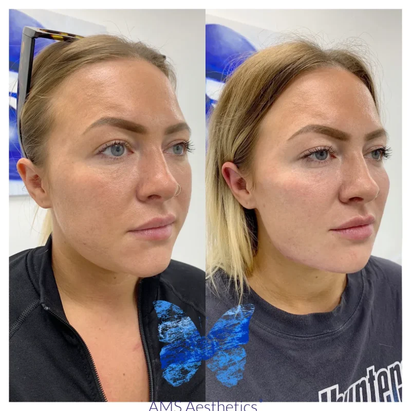Cheek Enhancement - Before and Afters 15