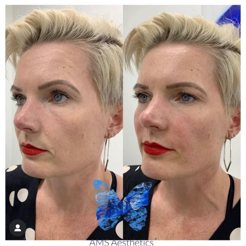 Cheek Enhancement - Before and Afters 16