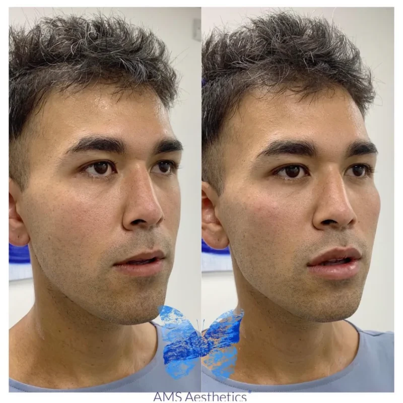 Cheek Enhancement - Before and Afters 17