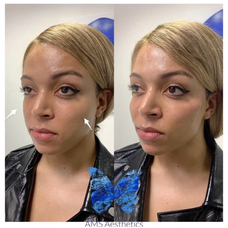 Cheek Enhancement - Before and Afters 18