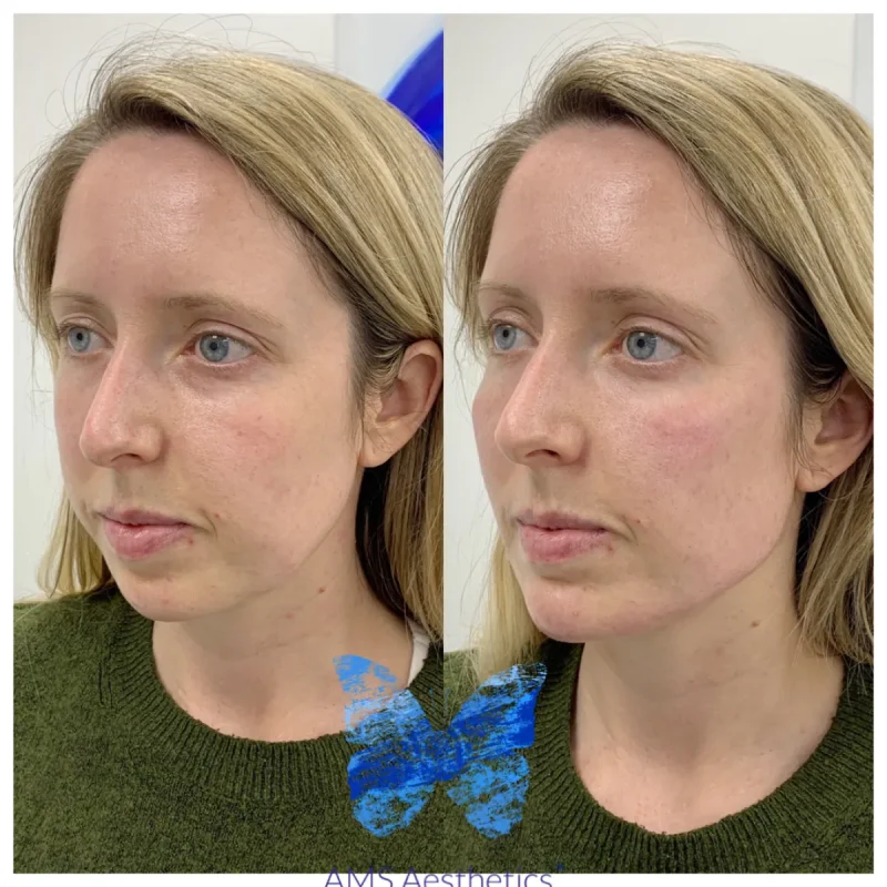 Cheek Enhancement - Before and Afters 2