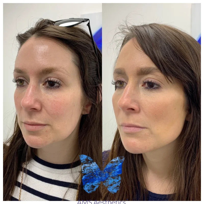 Cheek Enhancement - Before and Afters 3
