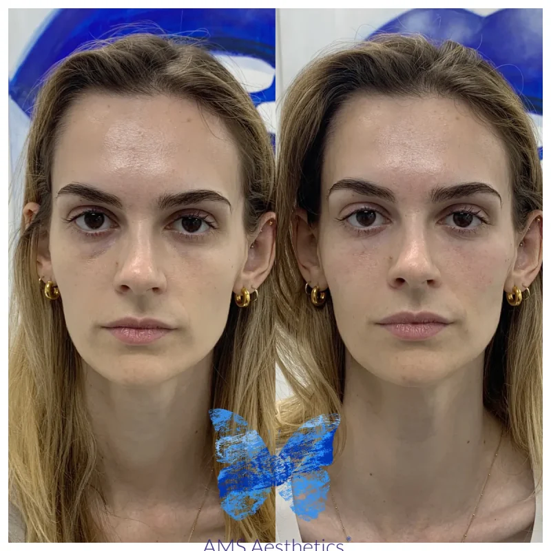 Cheek Enhancement - Before and Afters 5
