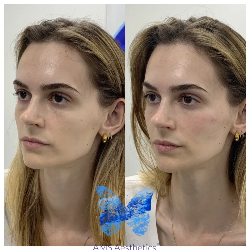 Cheek Enhancement - Before and Afters 7