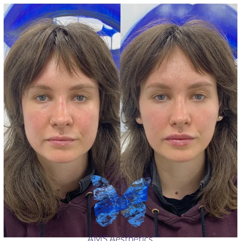 Cheek Enhancement - Before and Afters 8