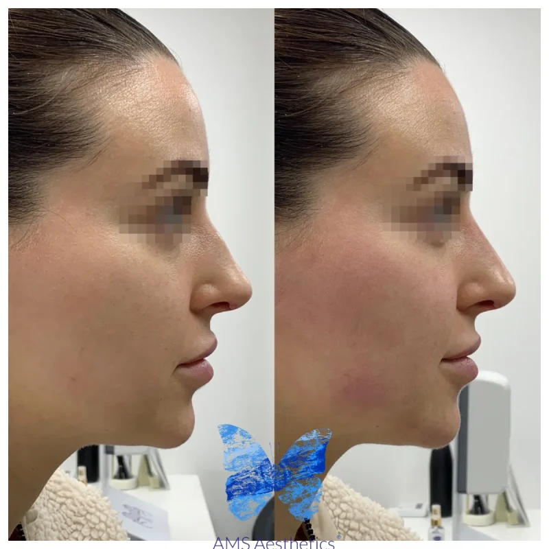 Non-surgical Rhinoplasty - Before and Afters 1