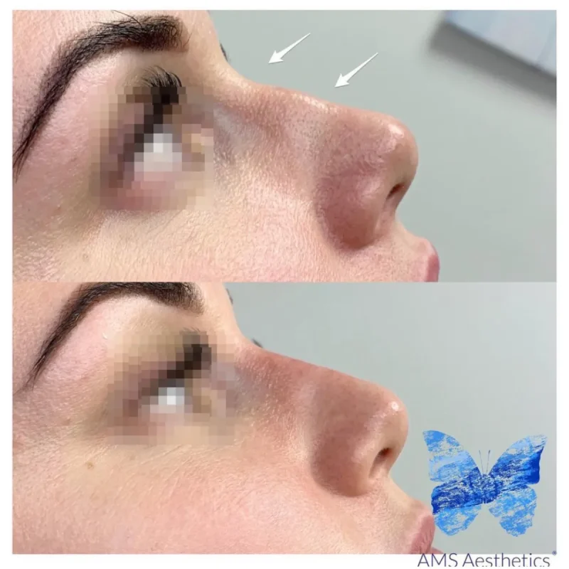 Non-surgical Rhinoplasty - Before and Afters 2