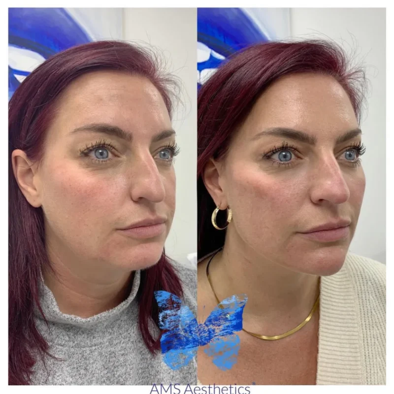Non-surgical Rhinoplasty - Before and Afters 3